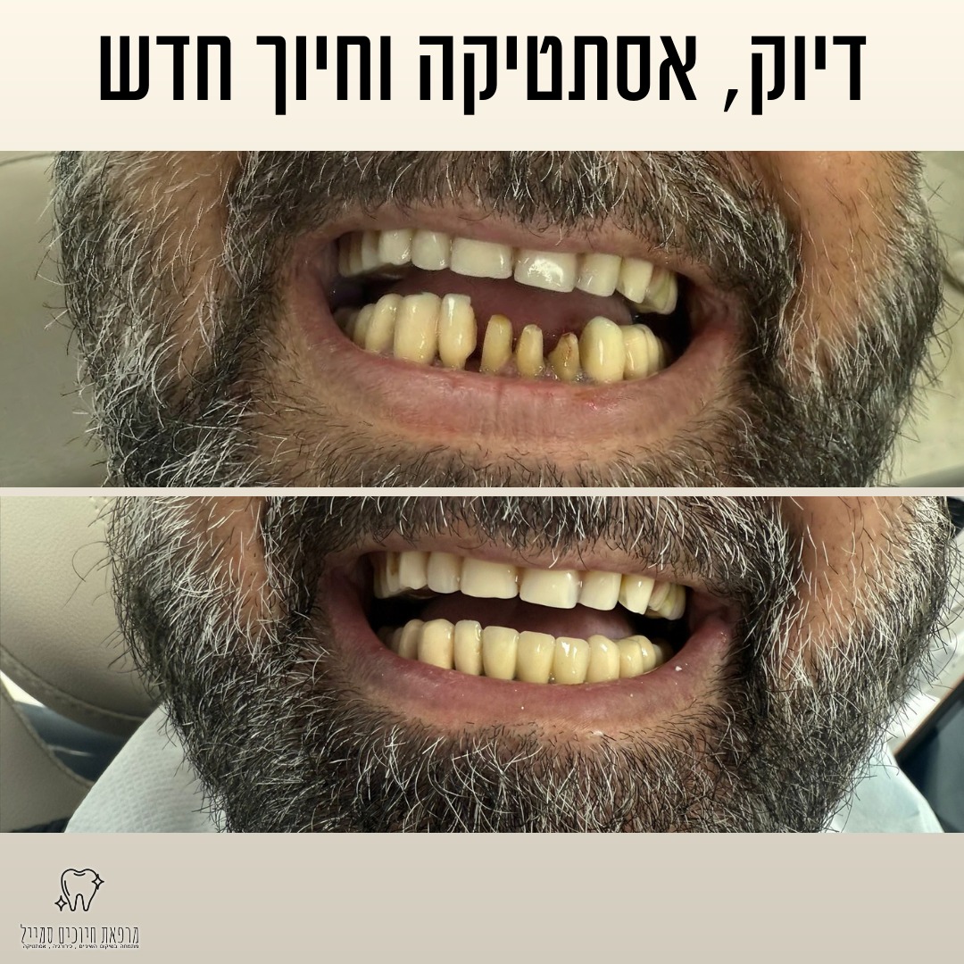 לפני ואחרי טיפול שיניים